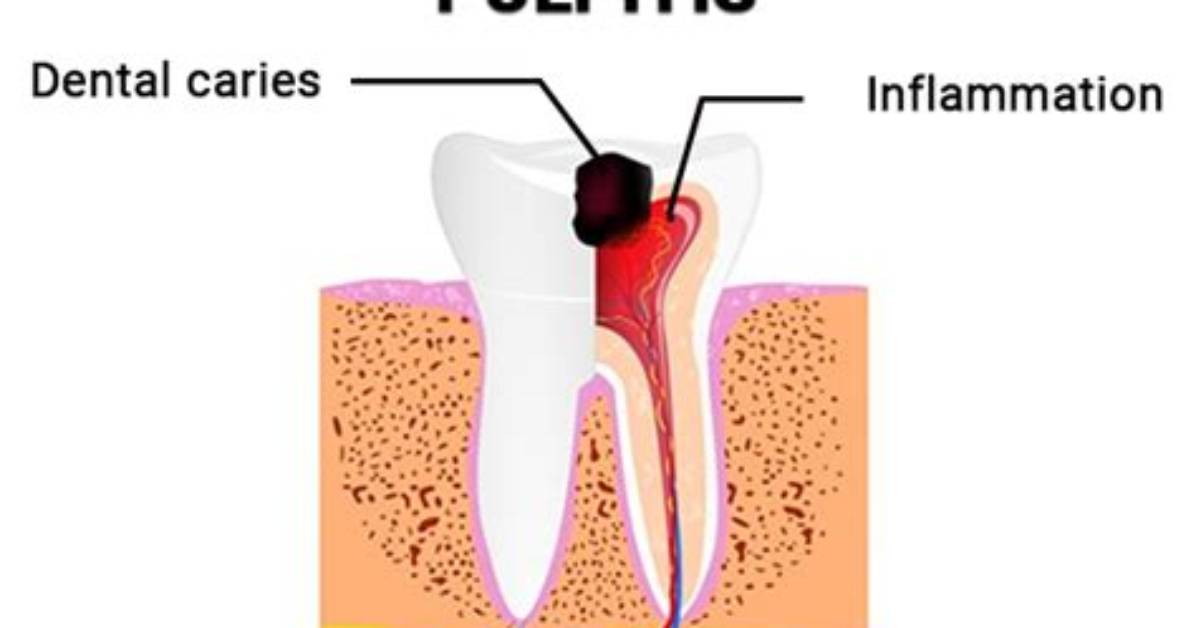 How Long Does Pulpitis Last After Filling
