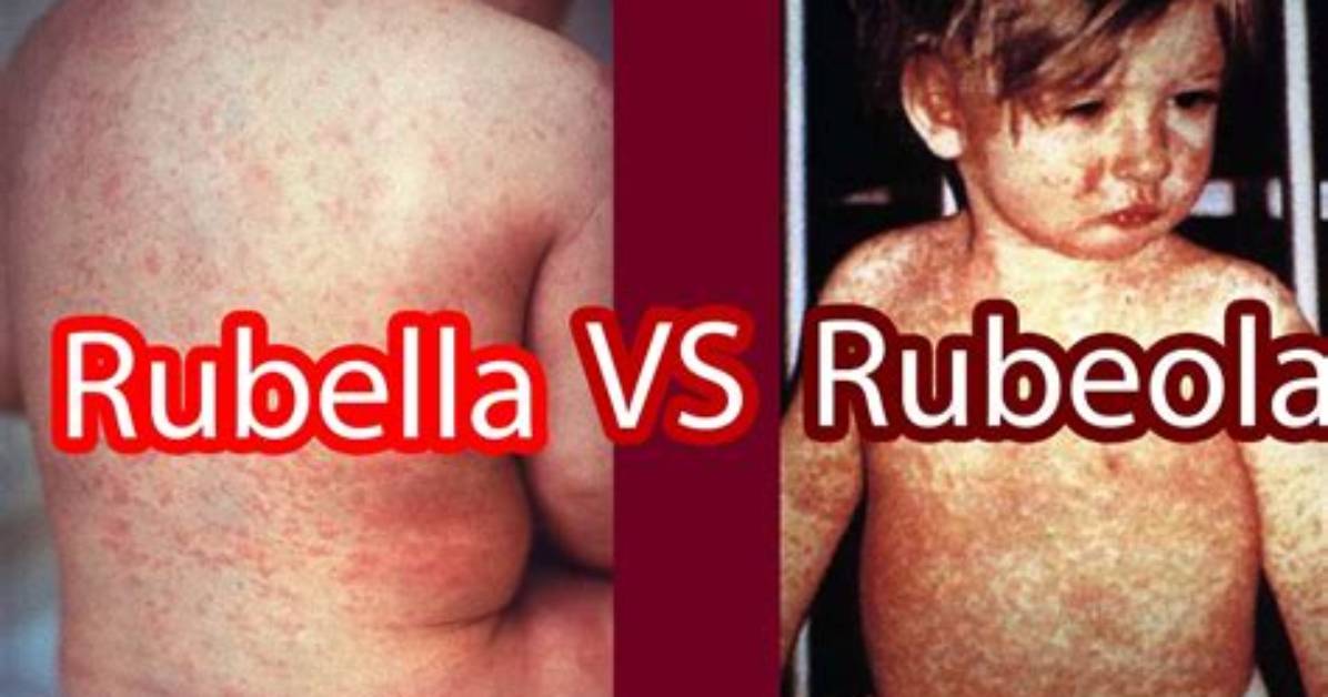 How Long Does Rubeola Last?