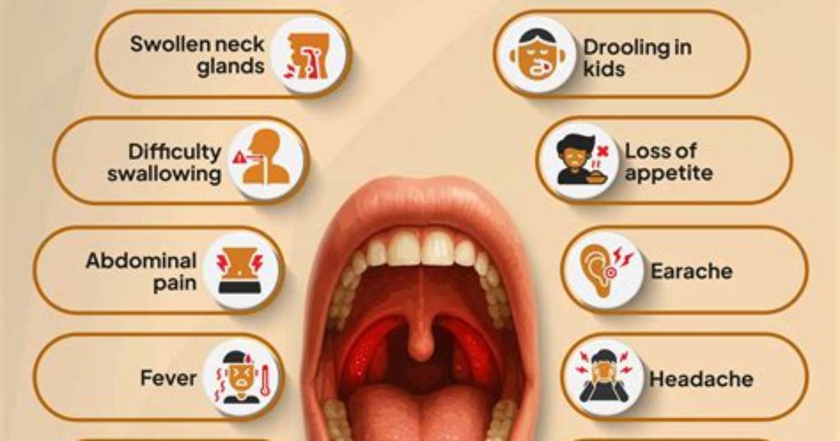 How Long Does Tonsillitis Last Without Treatment?