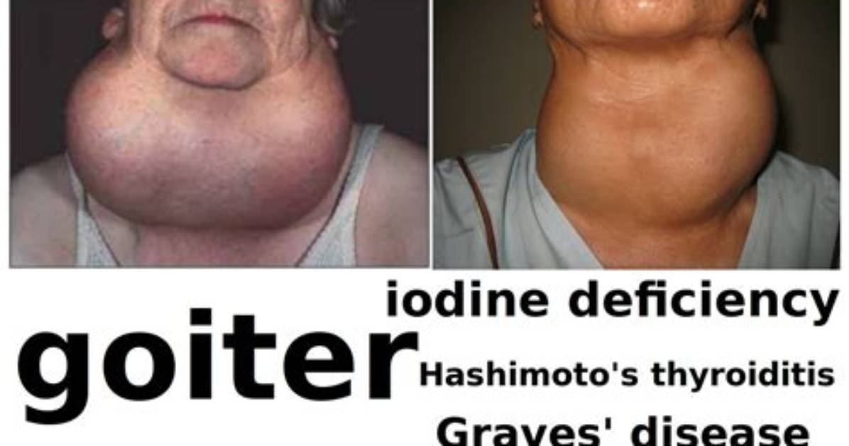 How Long for Goiter to Develop?