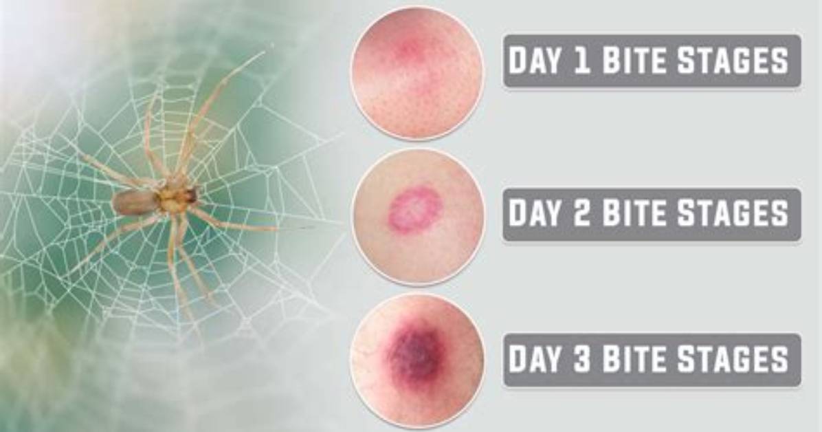 How Long Should a Spider Bite Last?