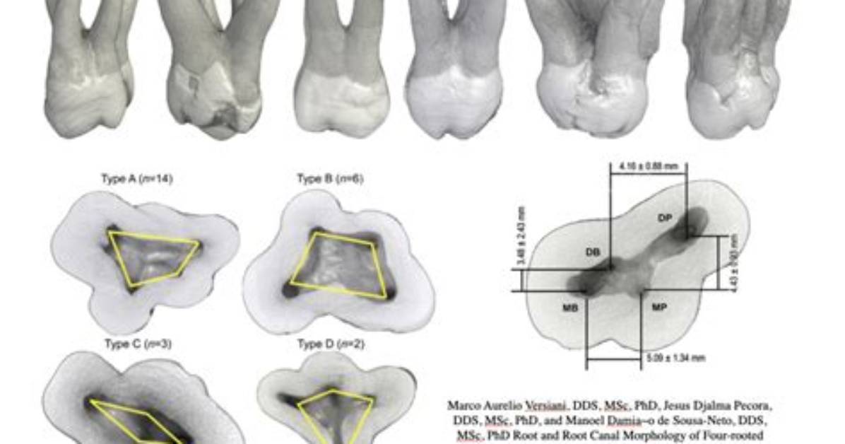 How Many Canals Does a Maxillary First Premolar Have