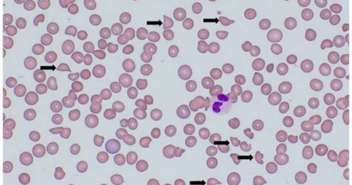 How Many Schistocytes in Ttp?