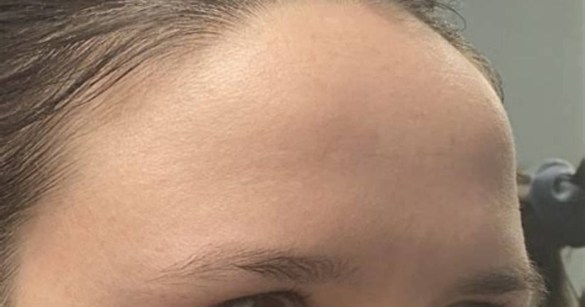 How Much Are Forehead Reductions?