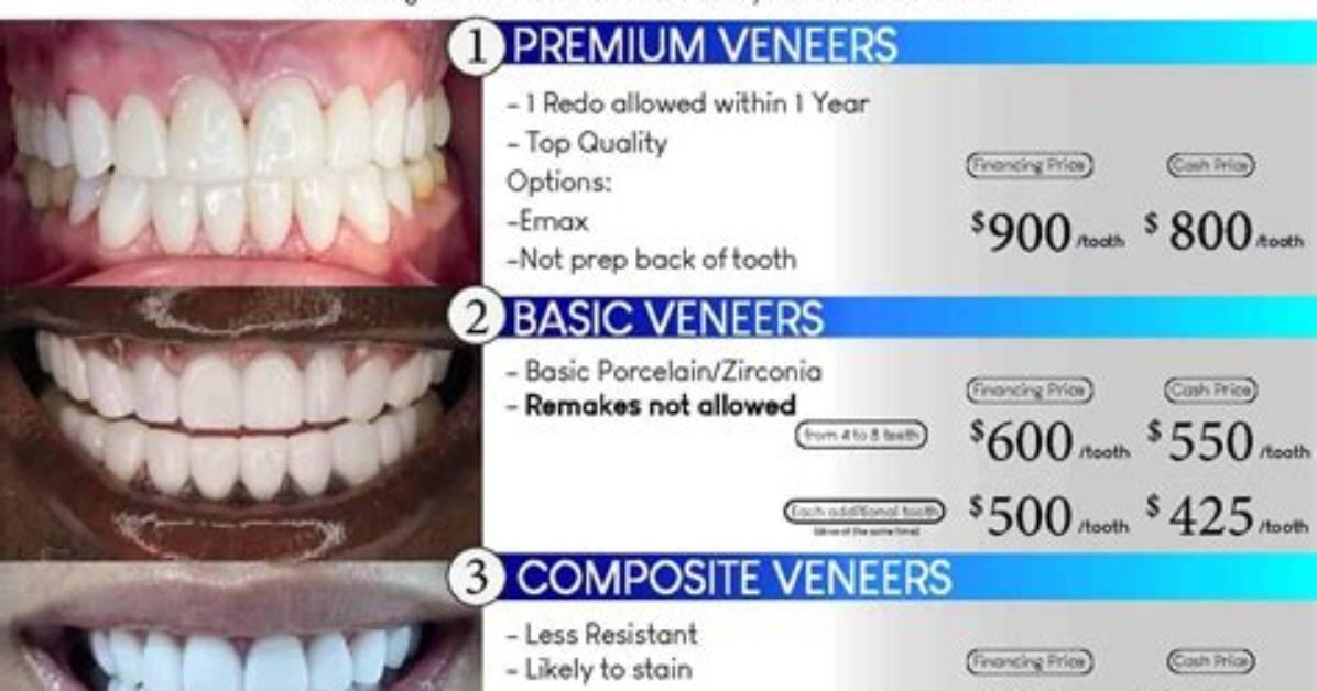 How Much Are Veneers Miami?