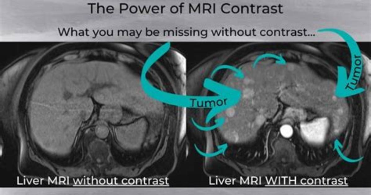 How Much Does an Mri with Contrast Cost?