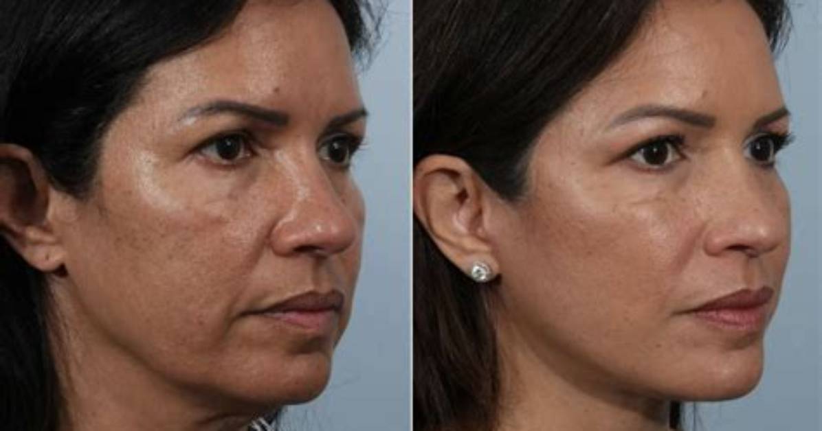 How Much Is a Facelift Surgery