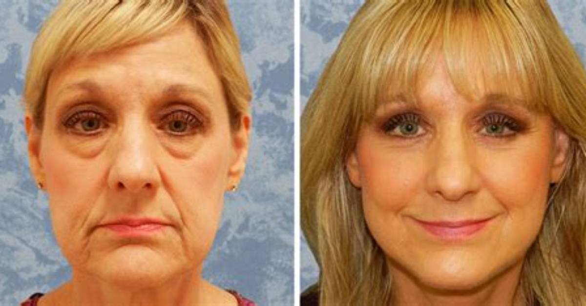 How Much Is a Scarless Facelift?