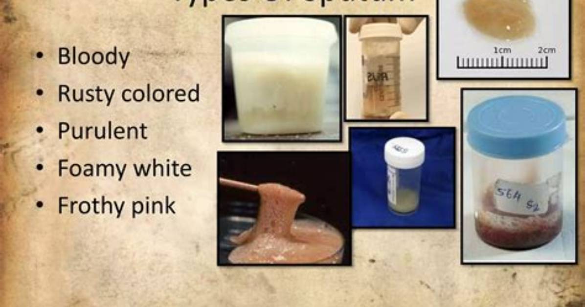How Much Sputum Is Needed for a Specimen?