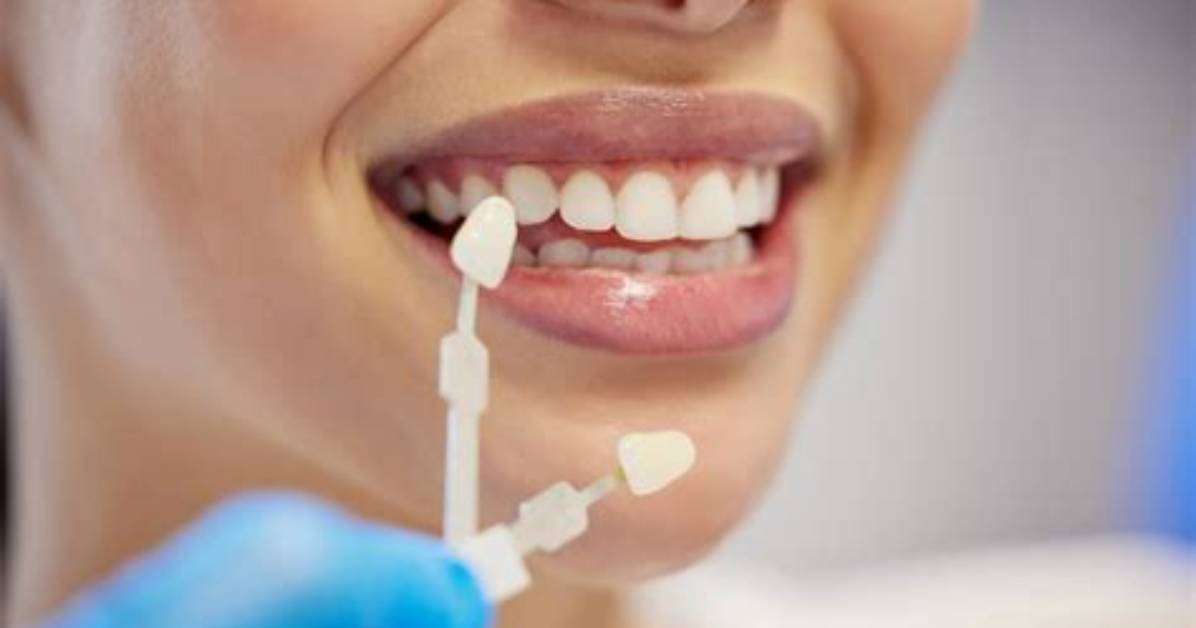 How Often Do Veneers Need to Be Replaced?