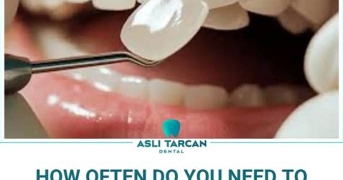 How Often Do You Replace Veneers?