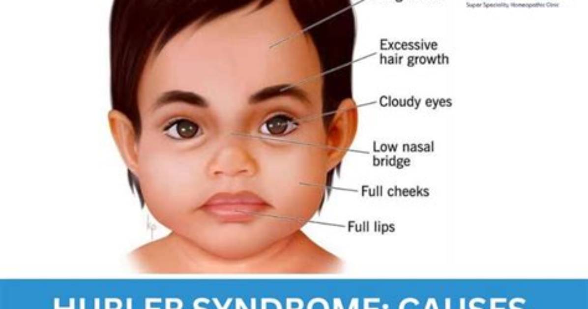 How Often Does Hurler Syndrome Occur?