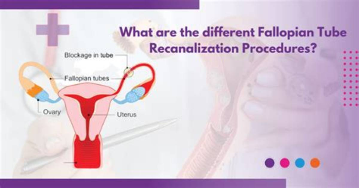 How Often Does Recanalization Occur