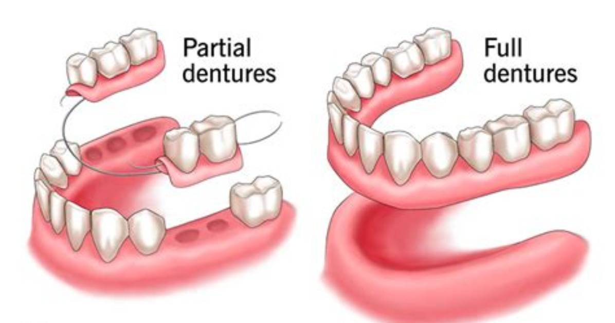 How Partial Dentures Are Made?