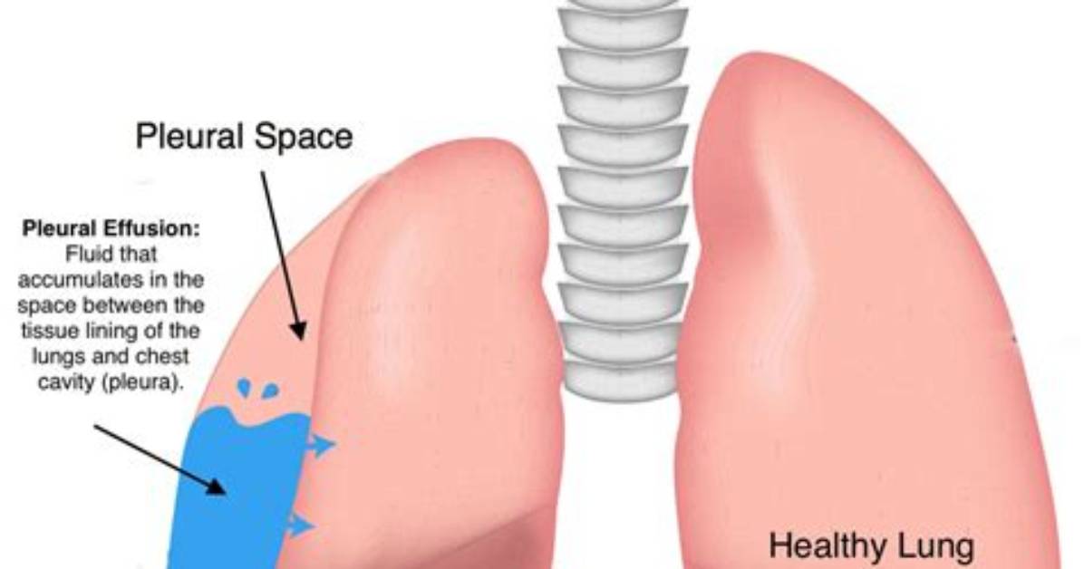 How Pleural Effusion Develops?