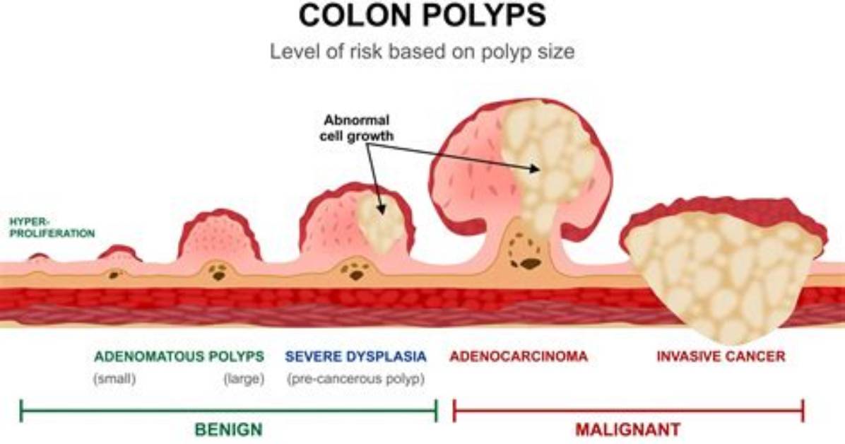 How Polyps Cause Bleeding?