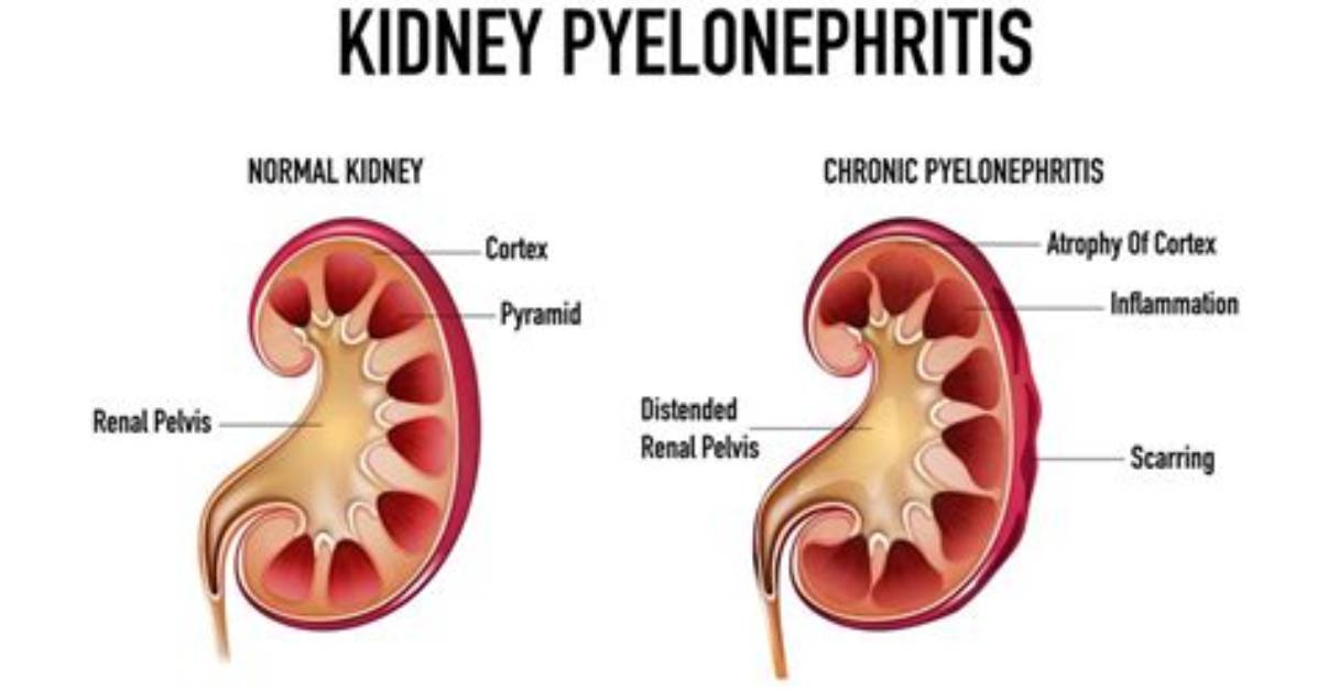 How Pyelonephritis Cause Hypertension?