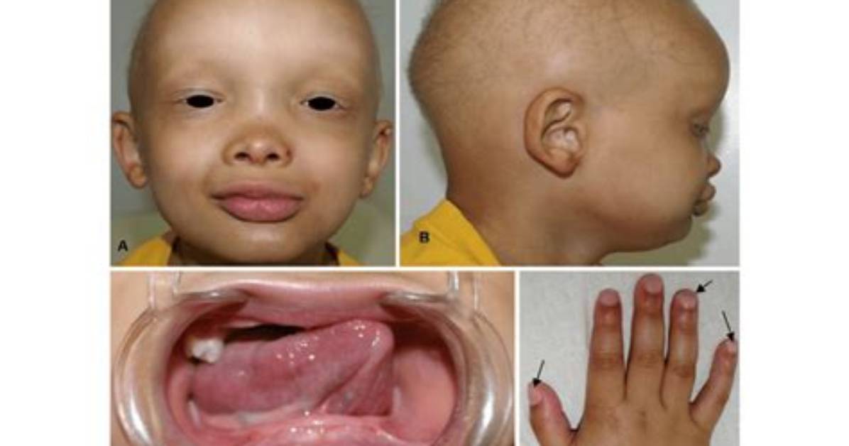 How Rare Is Ectodermal Dysplasia?