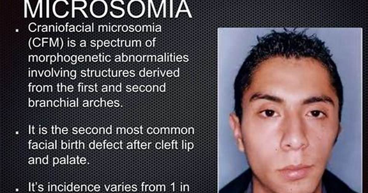 How Rare Is Microsomia?