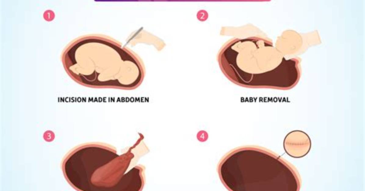 How Soon After C-Section Can You Walk?