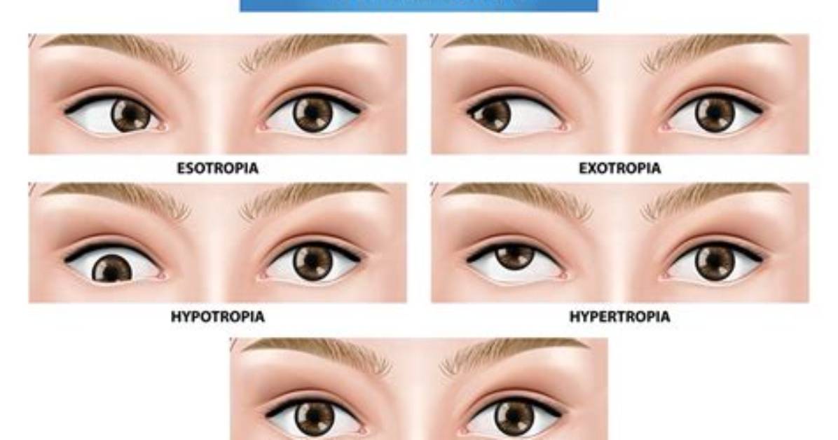 How Strabismus Affects Vision?