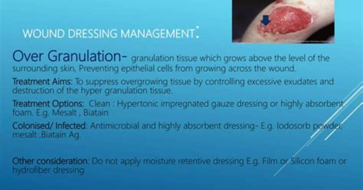 How to Clean a Granulating Wound?