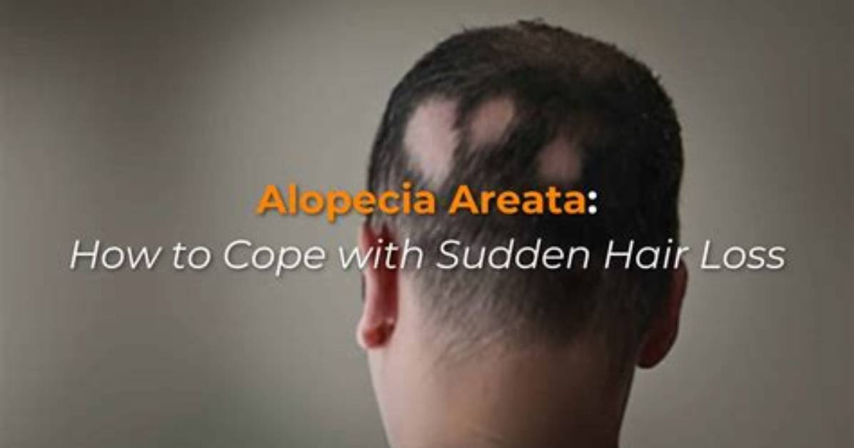 How to Cope with Alopecia
