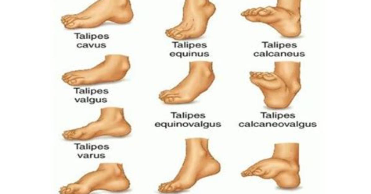 How to Correct Talipes?
