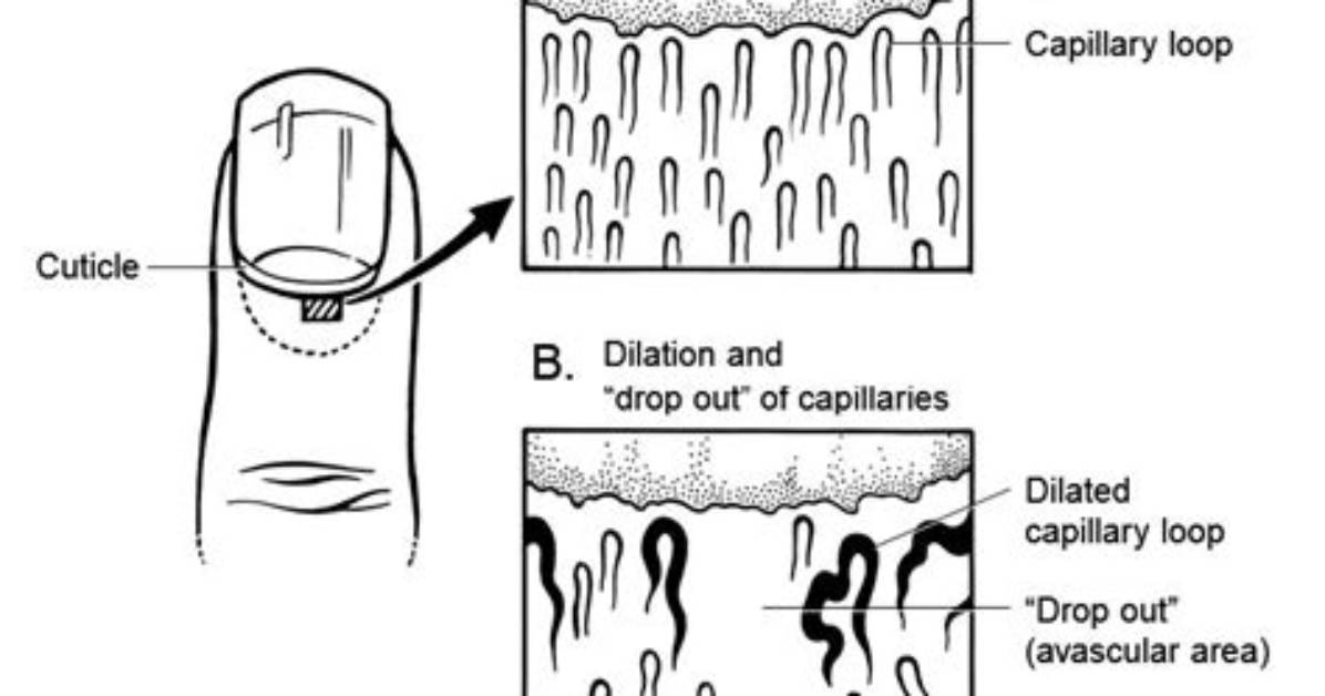 How to Do Nailfold Capillaroscopy?