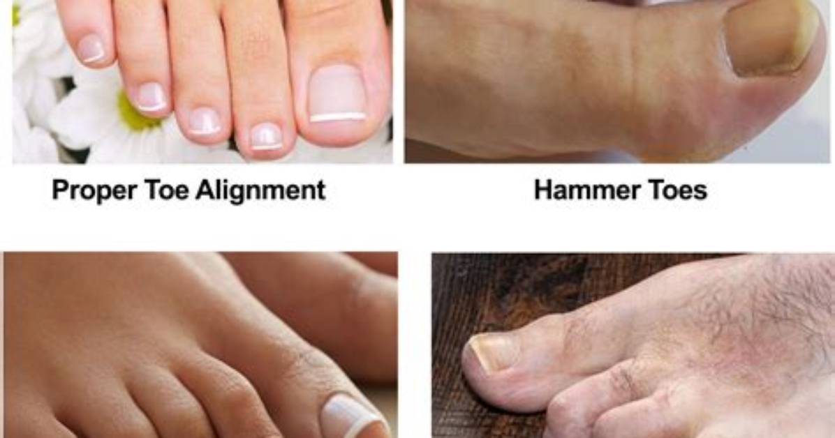 How to Fix Toes?