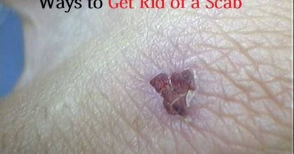 How to Get Rid of a Scab from a Pimple