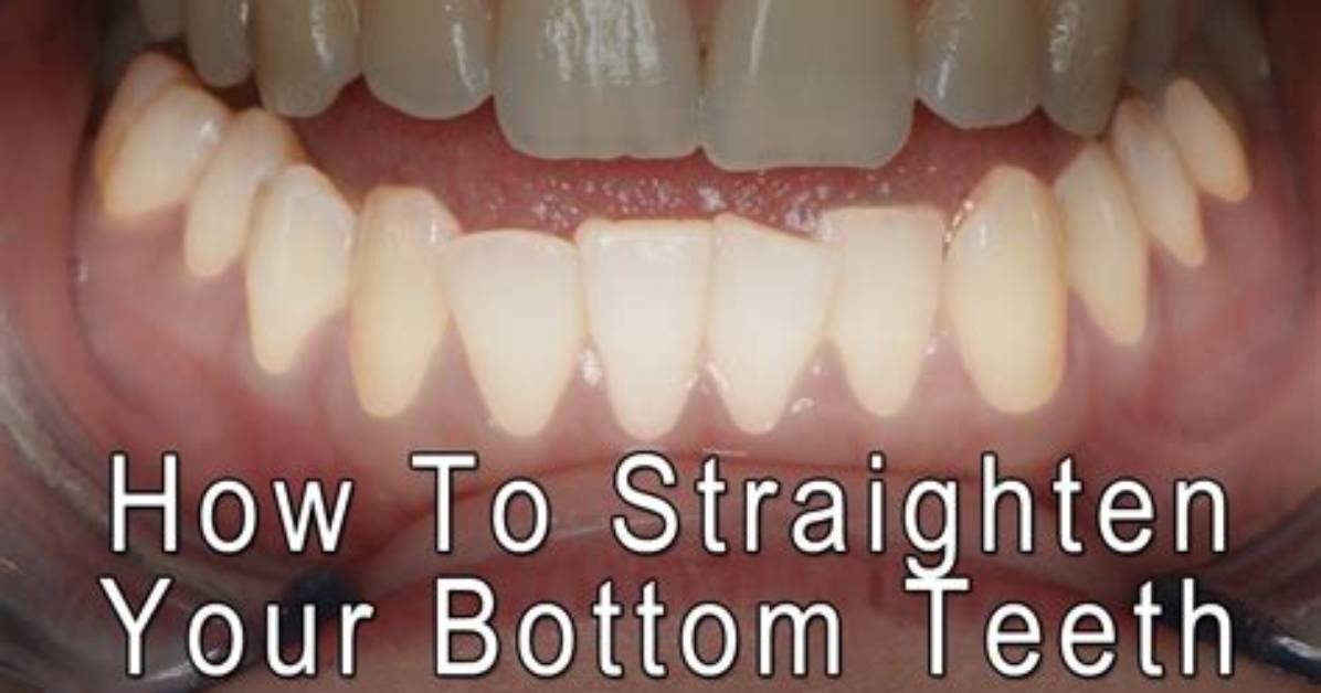 How to Get Straight Front Teeth?