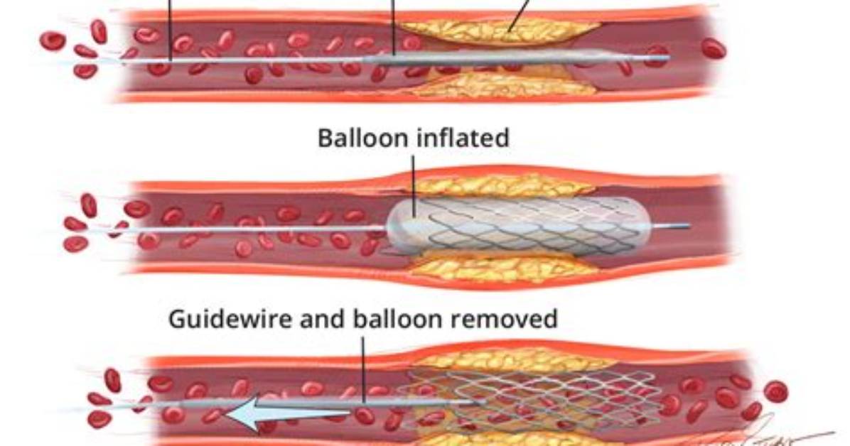 How to Prevent Atheromatous?