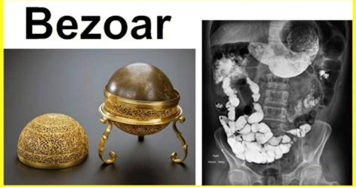 How to Prevent Bezoar Formation?
