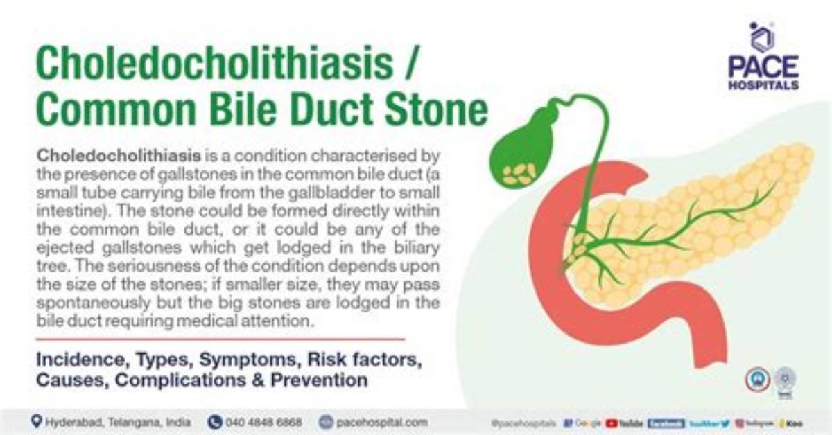 How to Prevent Choledocholithiasis?