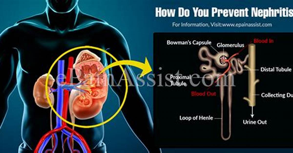 How to Prevent Nephritis?