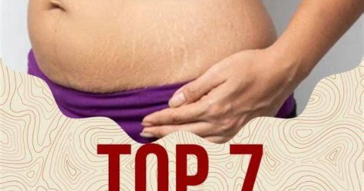 How to Reduce Stretch Marks