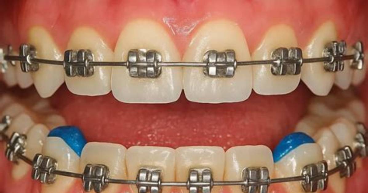 How to Remove Bite Blocks Braces
