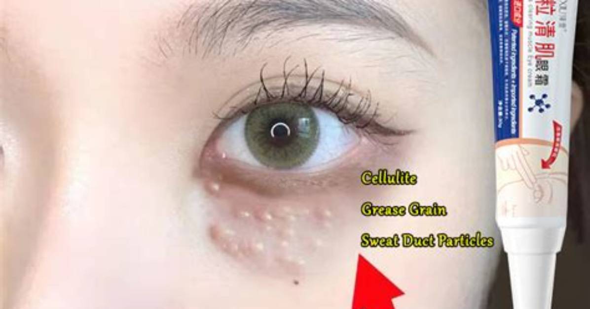 How to Remove Particles from the Eye?