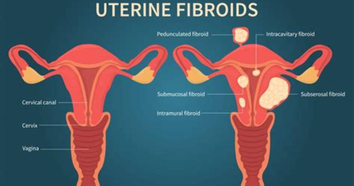 How to Remove Submucosal Fibroids?