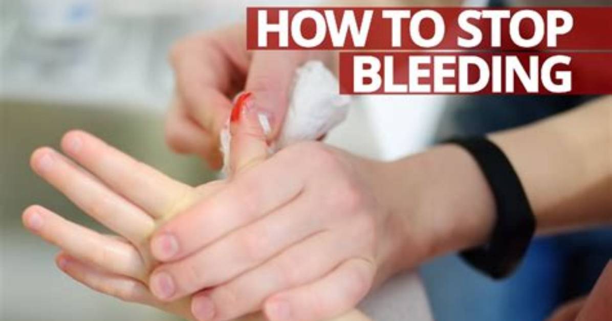 How to Stop Bleeding from Severed Finger?
