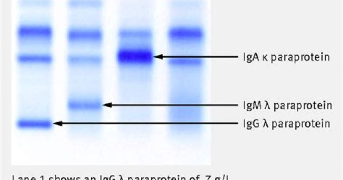 How to Test for Paraprotein?