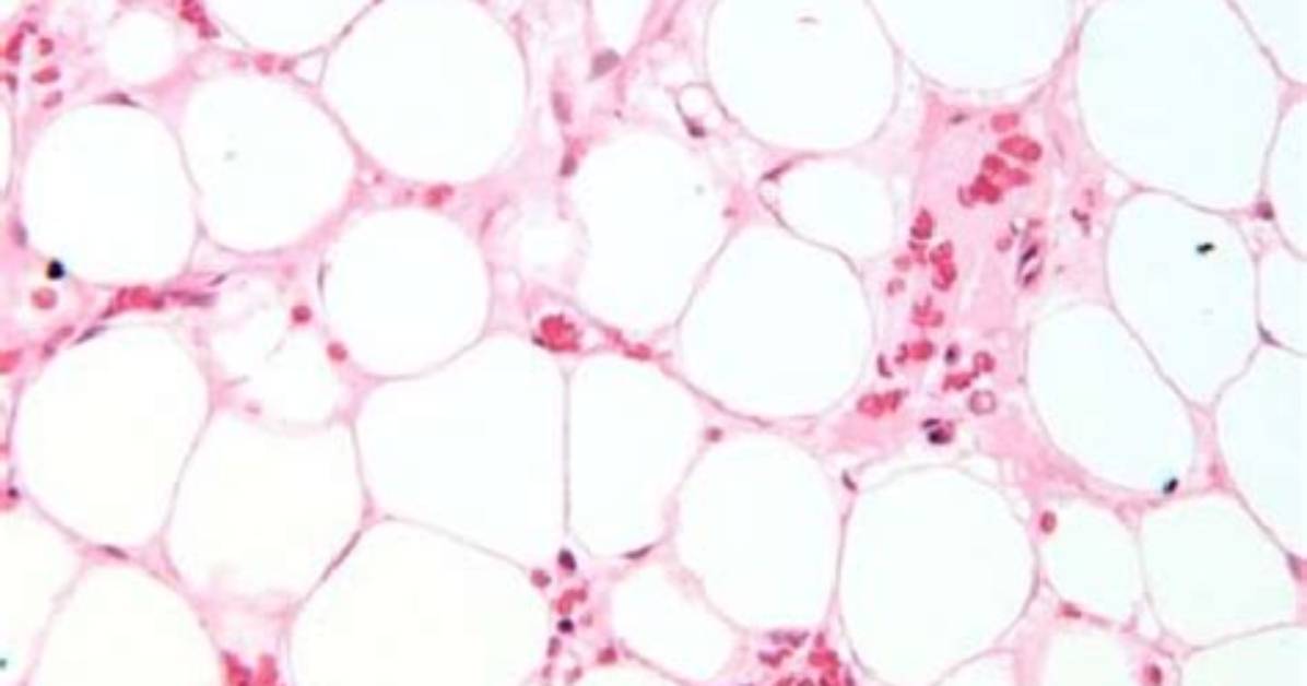 Hypoplastic Marrow