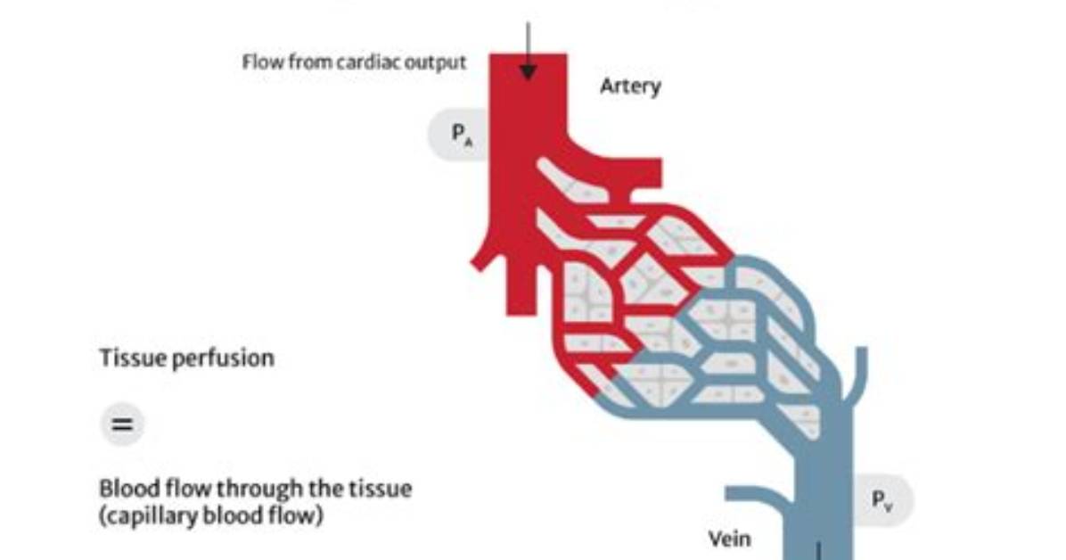 In Adequate Tissue Perfusion?
