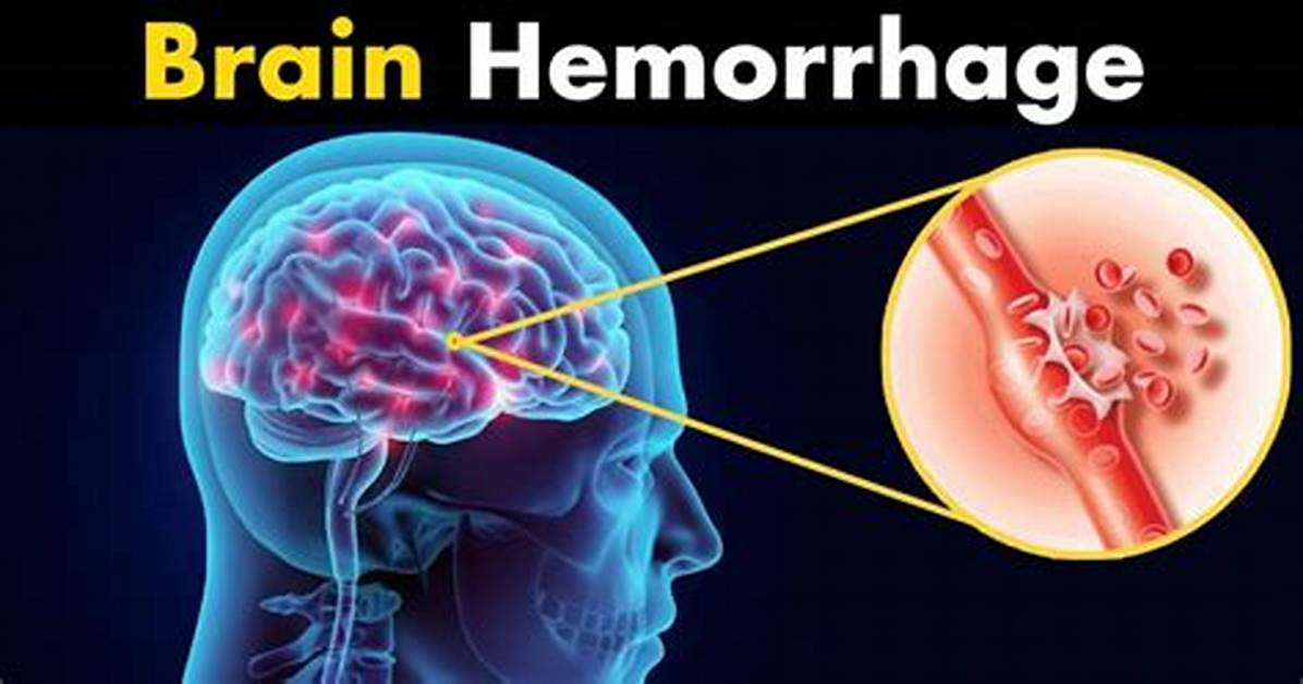 In Coma After Brain Haemorrhage?