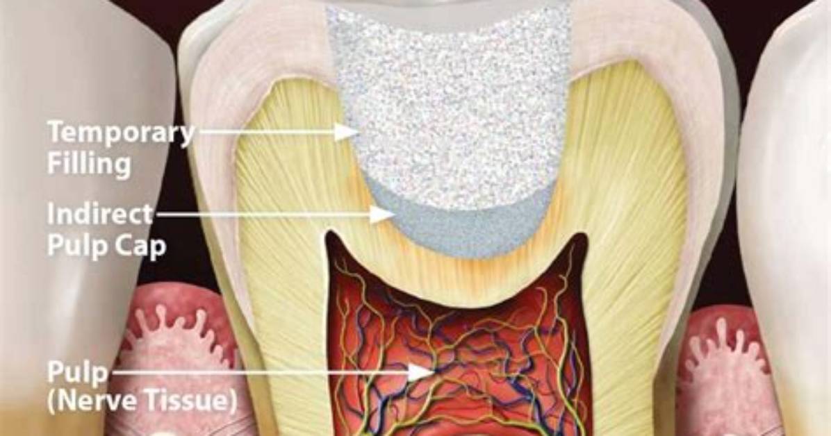 In Indirect Pulp Capping?