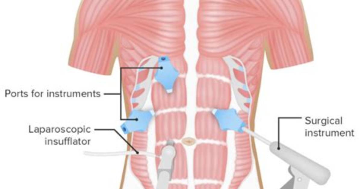 In Laparoscopy and Laparotomy?