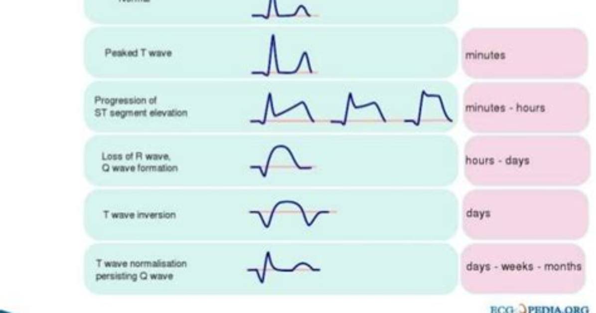 In Mi Ecg Changes?