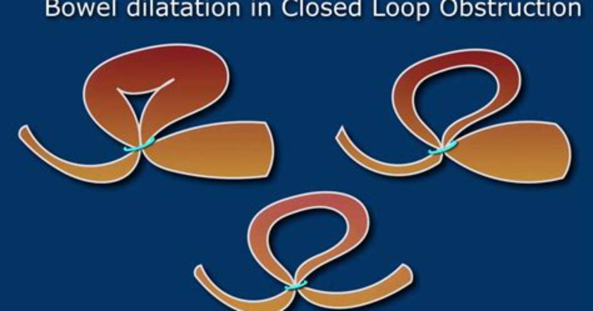 Is a Closed Loop Obstruction a Complete Obstruction