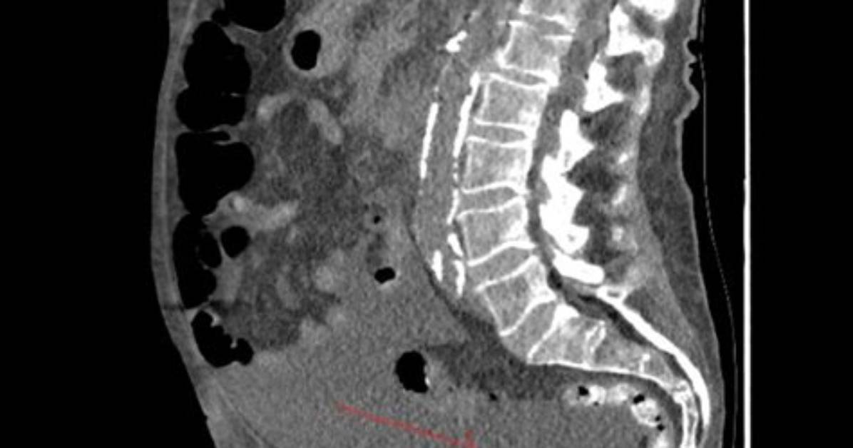 Is a Decompressed Bladder Bad?